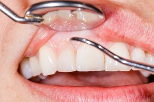 Five Risk Factors of Gum Disease